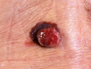 Amelanotic melanoma arising wihtin pigmented melanoma