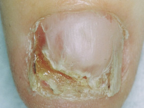Amelanotic melanoma of the nail unit