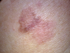 Amelanotic melanoma macro