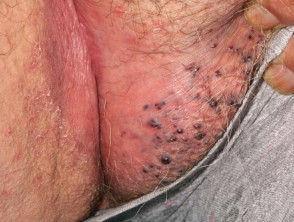 Angiokeratoma of Fordyce on vulva