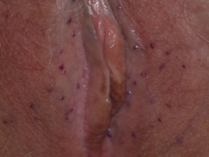 Angiokeratoma of Fordyce on vulva