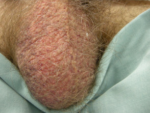 Angiokeratoma of Fordyce on scrotum