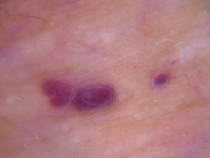 Dermoscopy of angiokeratoma of Fordyce on vulva