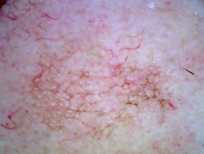 Asymmetrical pigmented follicular openings in pigmented actinic keratosis dermoscopy