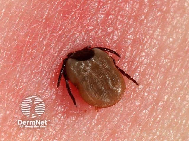 Tick bite