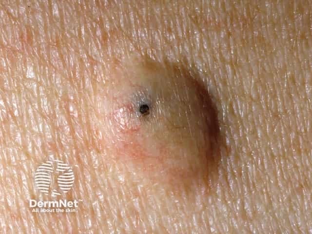 Epidermoid cyst with an obvious punctum