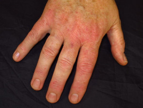 atopic dermatitis hand2