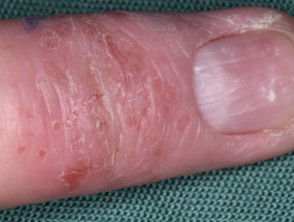 Atopic hand eczema
