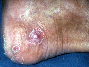 Cutaneous tuberculosis: Bazin disease