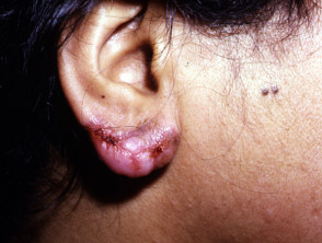 Cutaneous tuberculosis: lupus vulgaris