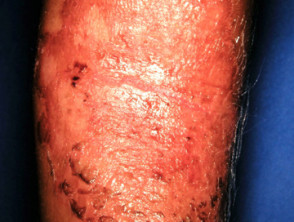 scalded skin syndrome
