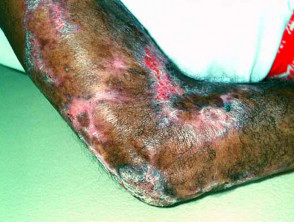 Lupus vulgaris