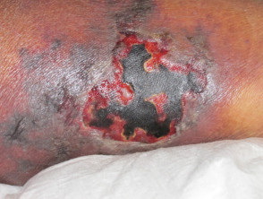 Wound infected by Aeromonas hydrophila causing necrotising cellulitis