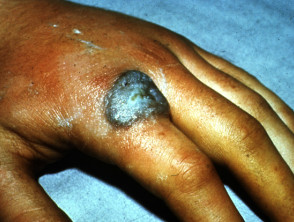 Cutaneous tuberculosis/warty tuberculosis