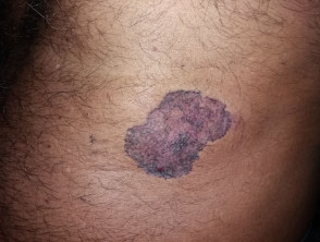 Basal cell carcinoma in skin of colour