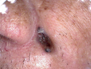 Basal cell carcinoma in skin of colour