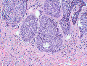 Basal cell carcinoma pathology