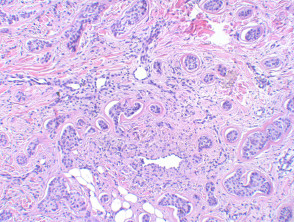 Basal cell carcinoma pathology