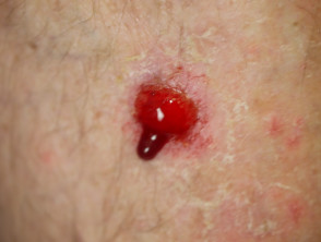 Bleeding skin cancer