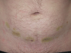 Bruising at site of heparin injections