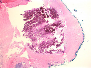 Calcinosis cutis histology