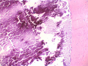 Calcinosis cutis histology