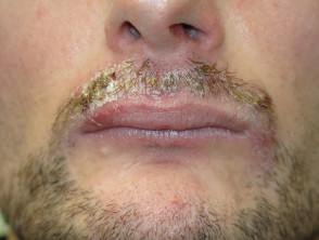 Candida albicans of moustache