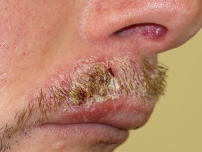 Candida albicans of moustache
