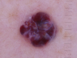 Cavernous haemangioma, polarised dermoscopy view