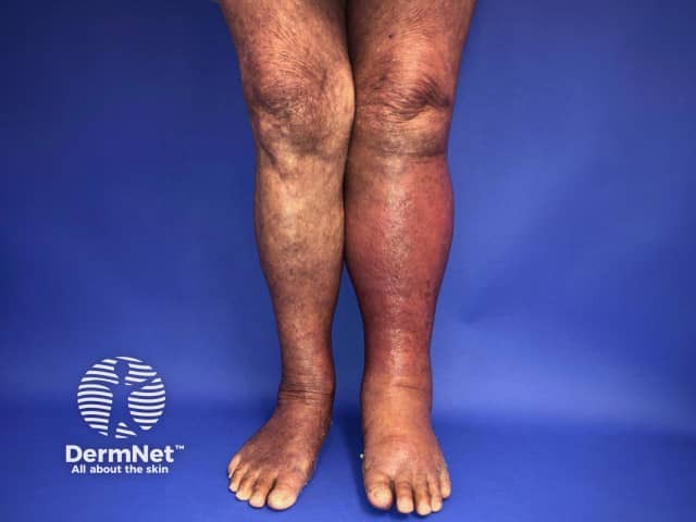 Cellulitis