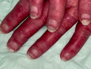 Muercke nails due to chemotherapy