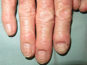 Hand dermatitis and chronic paronychia