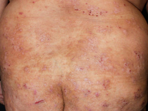 Scratching relating to dermatitis