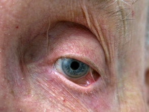Ocular cicatricial pemphigoid