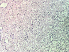 Clear cell fibrous papule pathology