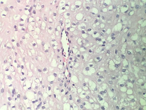 Clear cell fibrous papule pathology