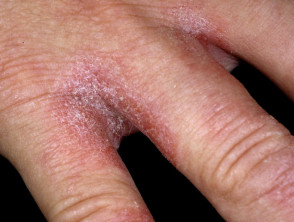 Hand dermatitis due to excessive exposure to water