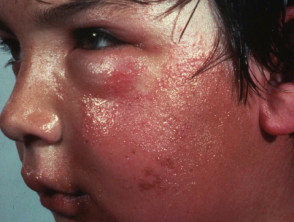 Severe contact allergic dermatitis in a child