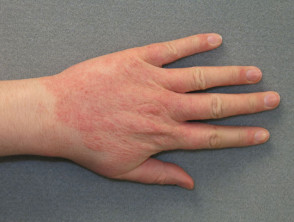 Contact dermatitis due to washing