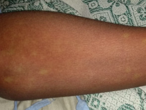 Dengue rash