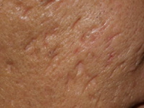 atrophic acne scars s