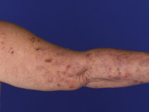 Dermatitis herpetiformis of elbow