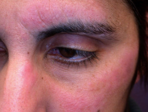 Contact allergic dermatitis around the eye