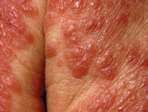Contact allergic dermatitis of the hands 