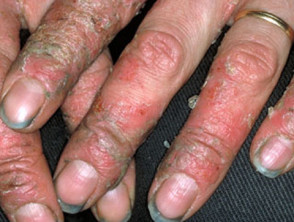 Contact allergic dermatitis of the hands 