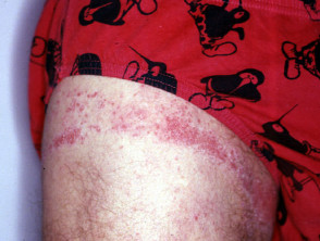 Rubber dermatitis