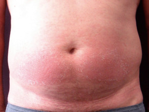Contact allergic dermatitis of the torso 