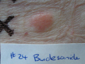 Positive patch test to budesonide