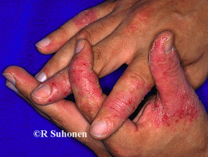 Hand dermatitis
