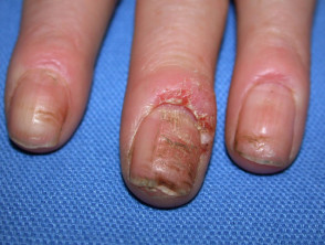 Hand dermatitis